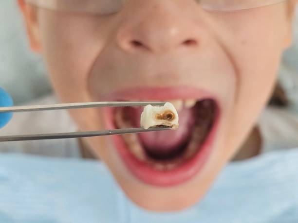 Best Emergency Root Canal Treatment in Vandalia, IL