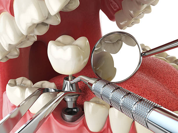Best Emergency Dental Care for Broken or Chipped Teeth in Vandalia, IL